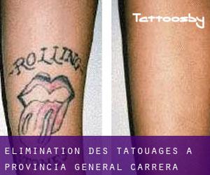 Élimination des tatouages à Provincia General Carrera