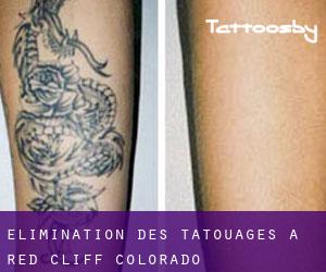 Élimination des tatouages à Red Cliff (Colorado)