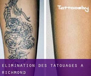 Élimination des tatouages à Richmond