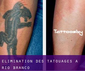 Élimination des tatouages à Rio Branco