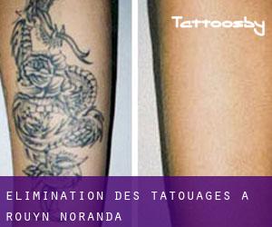 Élimination des tatouages à Rouyn-Noranda