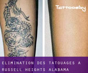 Élimination des tatouages à Russell Heights (Alabama)