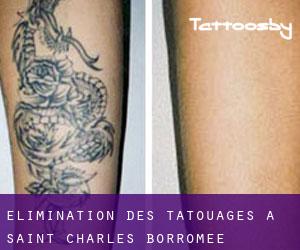 Élimination des tatouages à Saint-Charles-Borromée