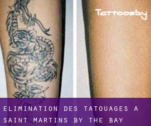 Élimination des tatouages à Saint Martins by the Bay