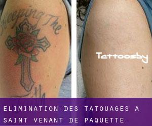 Élimination des tatouages à Saint-Venant-de-Paquette