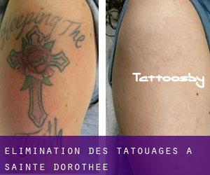 Élimination des tatouages à Sainte-Dorothée