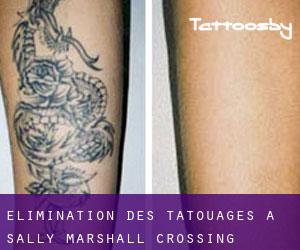 Élimination des tatouages à Sally Marshall Crossing