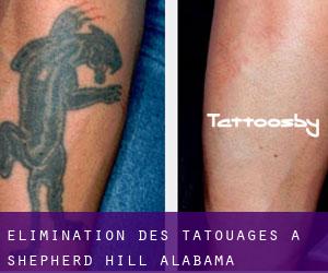 Élimination des tatouages à Shepherd Hill (Alabama)