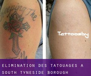 Élimination des tatouages à South Tyneside (Borough)