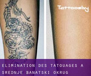 Élimination des tatouages à Srednje Banatski Okrug