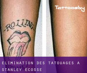 Élimination des tatouages à Stanley (Ecosse)