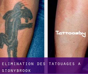 Élimination des tatouages à Stonybrook