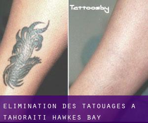 Élimination des tatouages à Tahoraiti (Hawke's Bay)