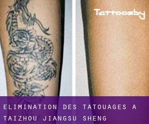 Élimination des tatouages à Taizhou (Jiangsu Sheng)