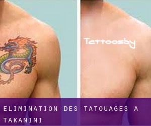 Élimination des tatouages à Takanini