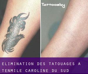 Élimination des tatouages à Tenmile (Caroline du Sud)