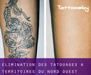 Élimination des tatouages à Territoires du Nord-Ouest