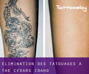 Élimination des tatouages à The Cedars (Idaho)