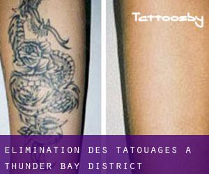 Élimination des tatouages à Thunder Bay District