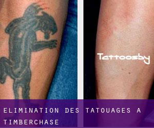 Élimination des tatouages à Timberchase