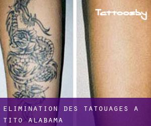 Élimination des tatouages à Tito (Alabama)