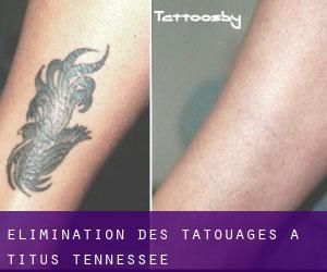 Élimination des tatouages à Titus (Tennessee)