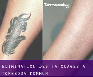 Élimination des tatouages à Töreboda Kommun