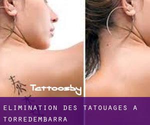 Élimination des tatouages à Torredembarra