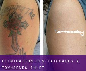 Élimination des tatouages à Townsends Inlet