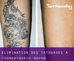 Élimination des tatouages à Tsumadinskiy Rayon
