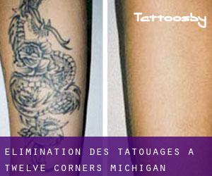 Élimination des tatouages à Twelve Corners (Michigan)