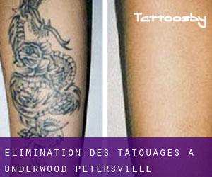 Élimination des tatouages à Underwood-Petersville
