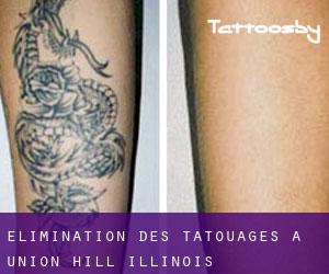 Élimination des tatouages à Union Hill (Illinois)
