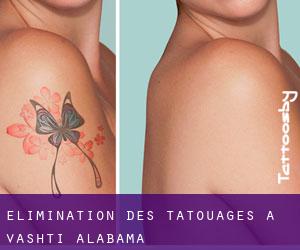 Élimination des tatouages à Vashti (Alabama)