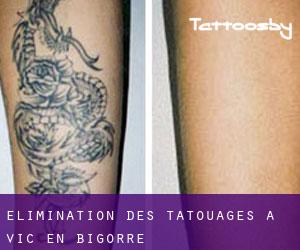 Élimination des tatouages à Vic-en-Bigorre