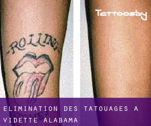 Élimination des tatouages à Vidette (Alabama)