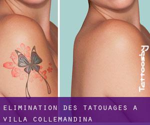 Élimination des tatouages à Villa Collemandina