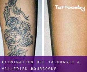 Élimination des tatouages à Villedieu (Bourgogne)