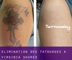 Élimination des tatouages à Virginia Shores