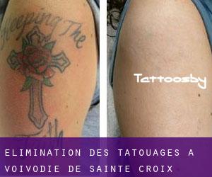 Élimination des tatouages à Voïvodie de Sainte-Croix