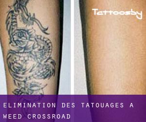 Élimination des tatouages à Weed Crossroad