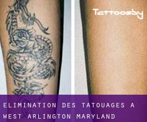 Élimination des tatouages à West Arlington (Maryland)