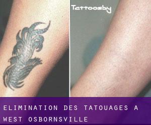 Élimination des tatouages à West Osbornsville