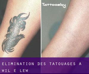 Élimination des tatouages à Wil-e-lew