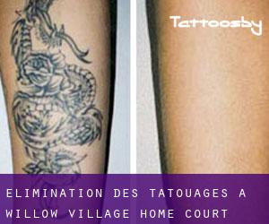 Élimination des tatouages à Willow Village Home Court