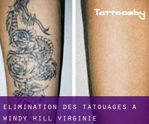 Élimination des tatouages à Windy Hill (Virginie)