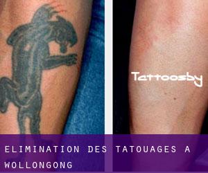 Élimination des tatouages à Wollongong