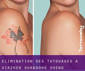 Élimination des tatouages à Xiazhen (Shandong Sheng)