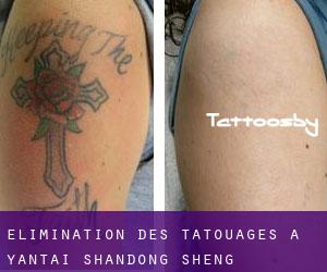 Élimination des tatouages à Yantai (Shandong Sheng)