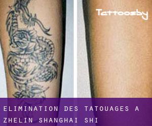 Élimination des tatouages à Zhelin (Shanghai Shi)